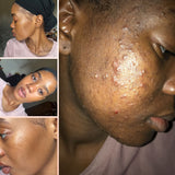 Acne consultation| Acne Treatment Package