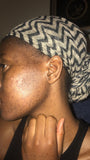 Acne consultation| Acne Treatment Package