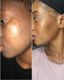Hyperpigmentation| Dark Spot Treatment (If you are looking to get rid of dark spots, this is the package for you!